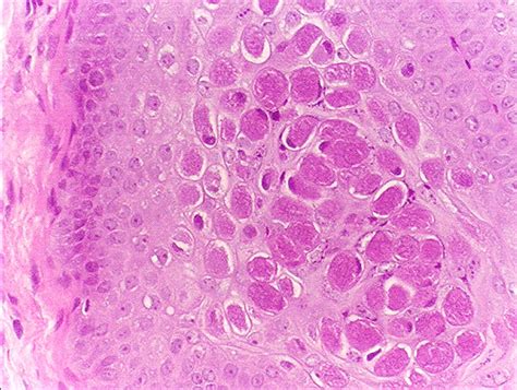 Filemolluscum Contagiosum 1