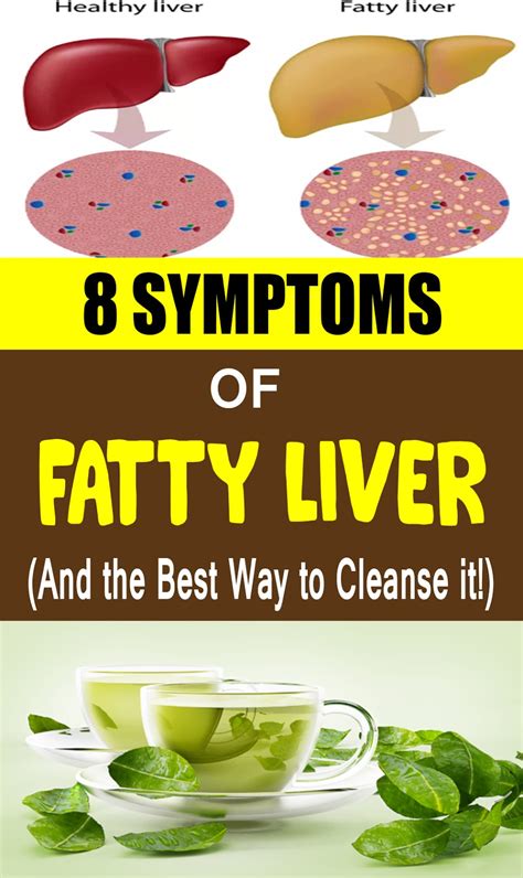 8 Common Symptoms of Fatty Liver (And the Best Way to Cleanse it!)