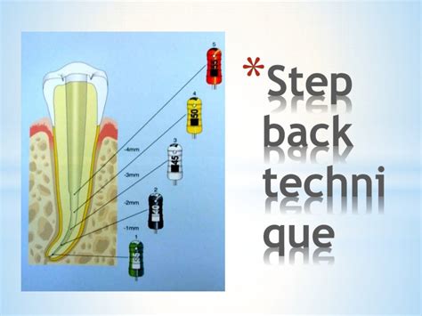 Root Canal Preparation Techniques Endodontic Treatment