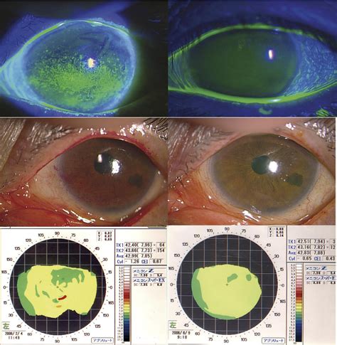 Surgical Punctal Occlusion With A High Heat Energy Releasing Cautery