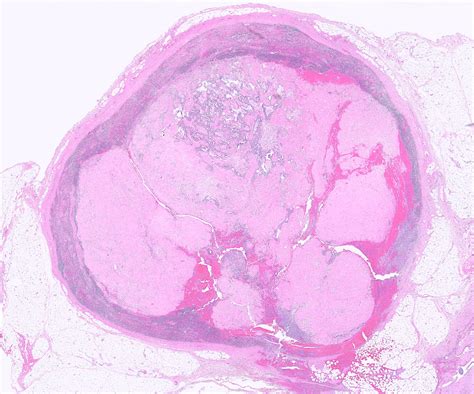 Greg Charville On Twitter Treated Synovial Sarcoma With Extensive