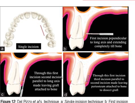 Figure From Year Journey Of Palatal Connective Tissue Graft