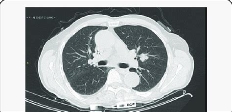 Ct Chest Showing Left Upper Lobe Mm Spiculated Bilobed Nodule Which