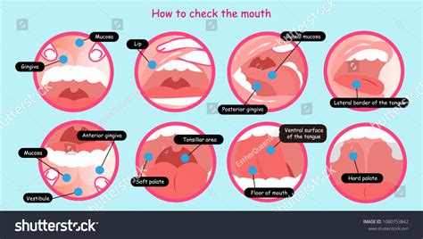 25 Imágenes De Buccal Mucosa Cancer Imágenes Fotos Y Vectores De