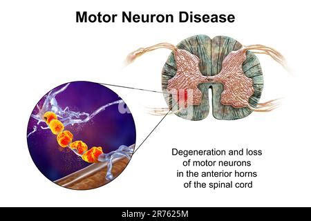 Motor Neuron Diseases Computer Illustration Showing Degeneration Of