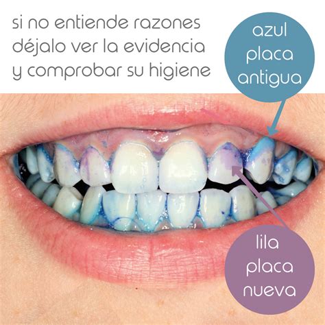 Reveladores De Placa Bacteriana qué Son Y Cómo Se 46 OFF