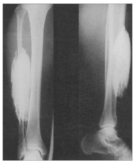 Diagnosis Calcific Myonecrosis Of The Calf Annals Of Saudi Medicine