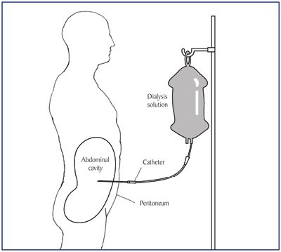 Peritoneal Catheter Placement