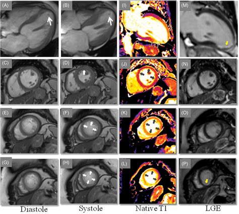 Cardiac Magnetic Resonance Cmr Imaging Reveals Mid‐apical Ballooning