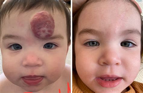 Superficial Hemangioma