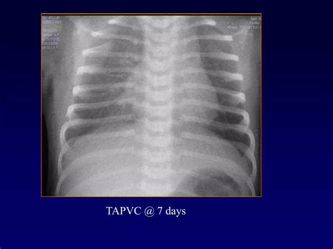 Approach To Cyanotic Congenital Heart Disease Ppt