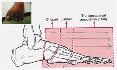 Foot Amputation Flashcards Quizlet