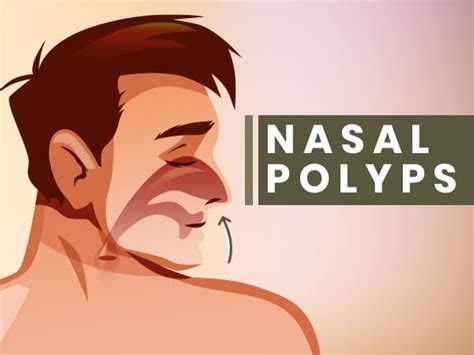 Nasal Polyps Is It A Serious Condition Know About Its Causes