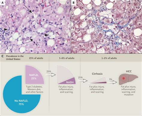 Cause Pathogenesis And Treatment Of Nonalcoholic Steatohepatitis Nejm