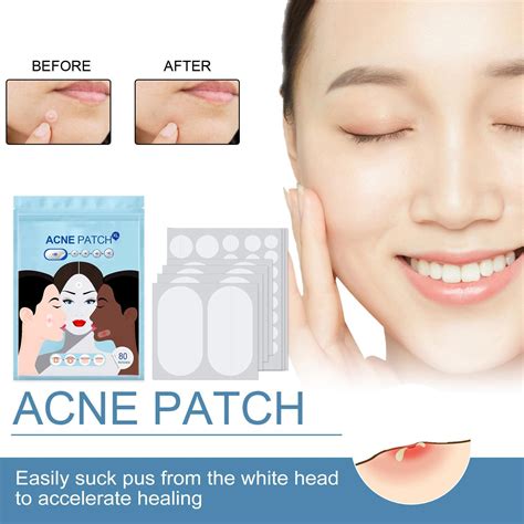 【new】big Pimple Patch 5 Sizes 80 Pieces Xl Hydrocolloid Bandage Full