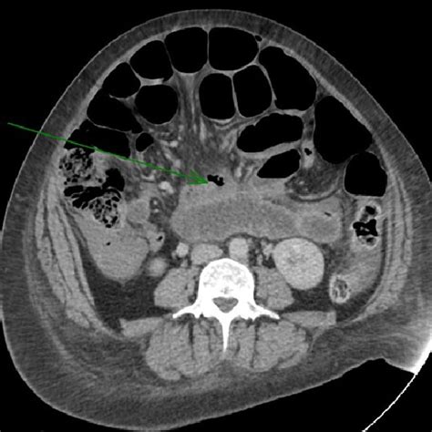 Computed Tomography Demonstrating Small Bowel Obstruction With A