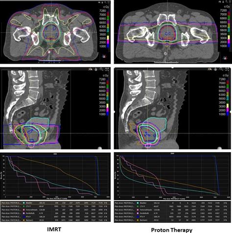 Figure Comparison Of Intensity Modulated Photon Therapy Imrt Versus Download Scientific