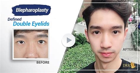 1 Week Recovery With Men Double Eyelid For Handsome Look