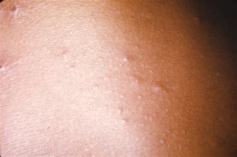 Brazilian hemorrhagic fever - wikidoc