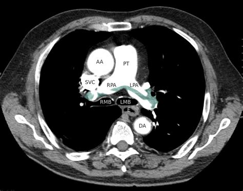 Saddle Pulmonary Embolism Xray