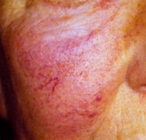 telangiectasia treatment - pictures, photos