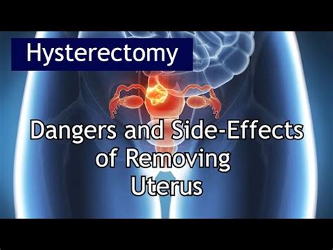 Hysterectomy Dangers Side Effects Antai Hospital Youtube