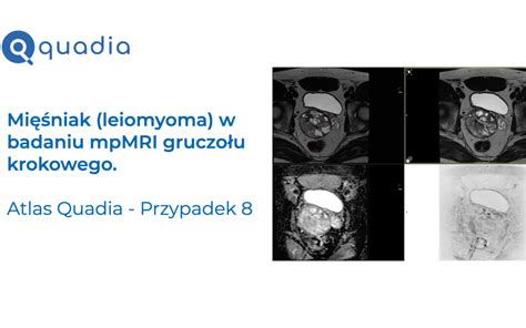 Przypadek Mi Niak Leiomyoma W Badaniu Mpmri Gruczo U Krokowego