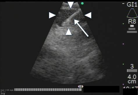 Pathological Diagnosis With Endobronchial Ultrasonography — Guided