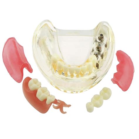 Amazon Dental Implant Typodont Restoration Teeth Model M