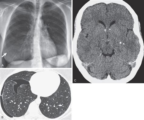 Lymphangioleiomyomatosis And Tuberous Sclerosis Radiology Key