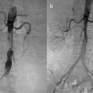 Vascular Imaging And Endovascular Procedure A Obvious Segmental