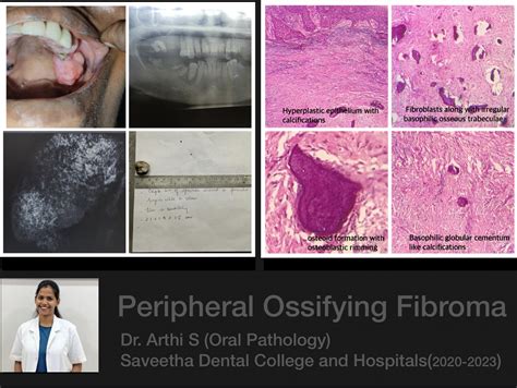 Peripheral Ossifying Fibroma Histology