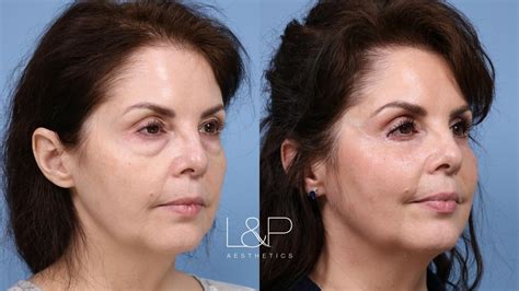 Lower Blepharoplasty Gone Wrong