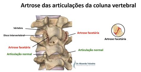 Denervação da Faceta Articular Dr Ricardo Teixeira