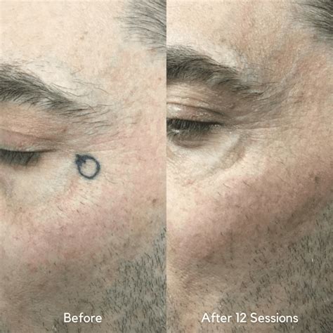 Vol 2 Best Of 2021 Before After Tattoo Removal Results Removery