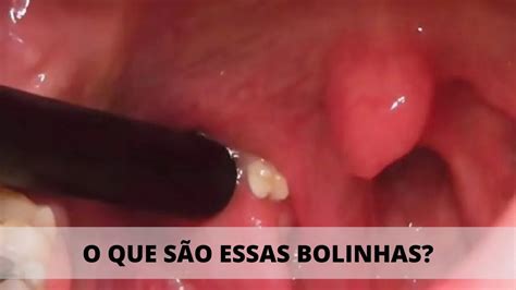 BOLINHAS MALCHEIROSAS QUE SAEM DA GARGANTA E MAU HÁLITO