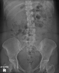 Mirizzi syndrome – Radiology Cases