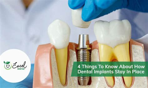 4 Things To Know About How Dental Implants Stay In Place