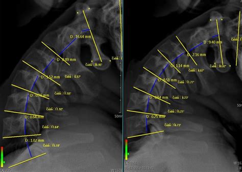 X Rays Lazarus Chiropractic