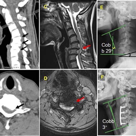 The Multilevel Compression Of Spinal Cord With Heterotopic Ossification Download Scientific