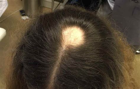 Alopecia Areata: Types, Causes + How It Affects Hair & Nail