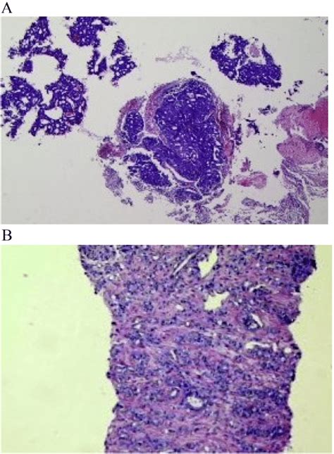 A Pathological Findings Of The Cerebellar Pontine Angle Metastatic