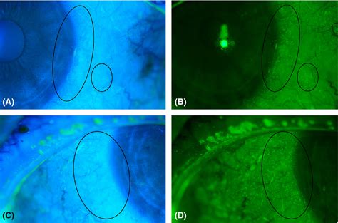 Micro‐instillation Of Fluorescein With An Inoculation Loop For Ocular