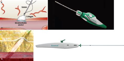 8 Vascular Closure Devices A Angio Seal® St Jude Medical St Paul