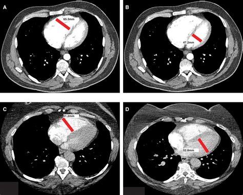 Loss Of Pulmonary Vascular Volume As A Predictor Of Right Ventricular Dysfunction And Mortality