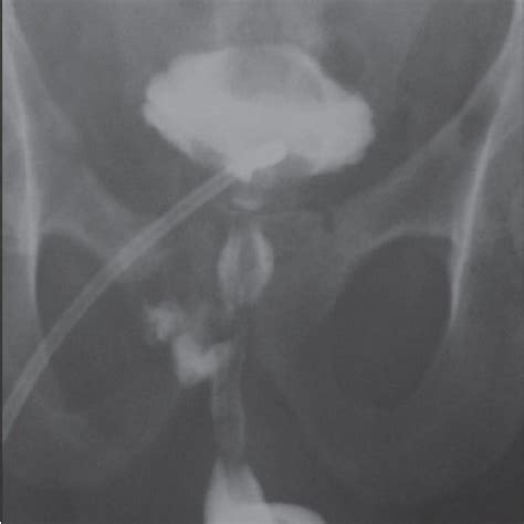 Pericatheter Ascending Urethrography Months After Early Urethral