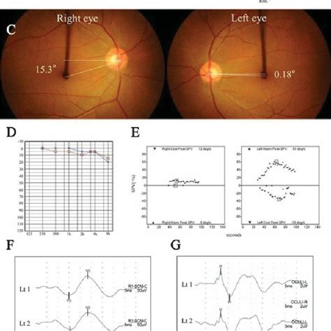 Clinical Features Of Superior Vestibular Neuritis A A Patient With Download Scientific