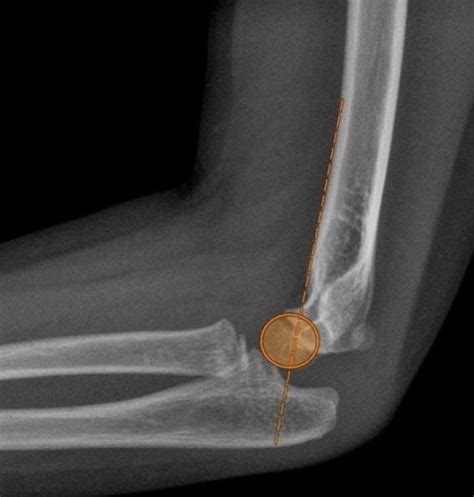 Anterior Humeral Line Ahl Download Scientific Diagram