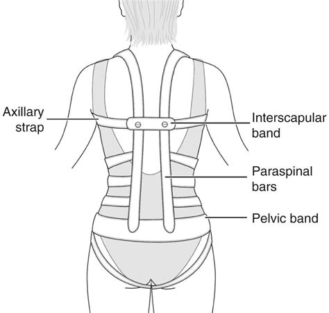 Principles And Components Of Spinal Orthoses Clinical Tree