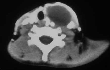 Cervical Ct Scan A Cystic Mass In The Left Lateral Of The Neck